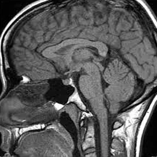 MRI Brain with Pituitary